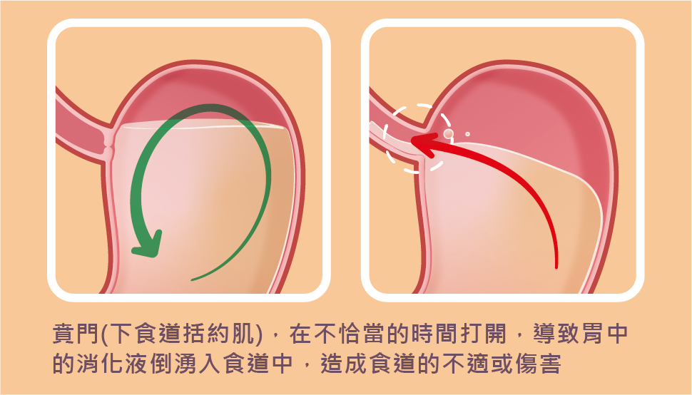 賁門在不恰當的時間打開,導致胃中的消化液倒湧入食道中,造成食道的不適或傷害。